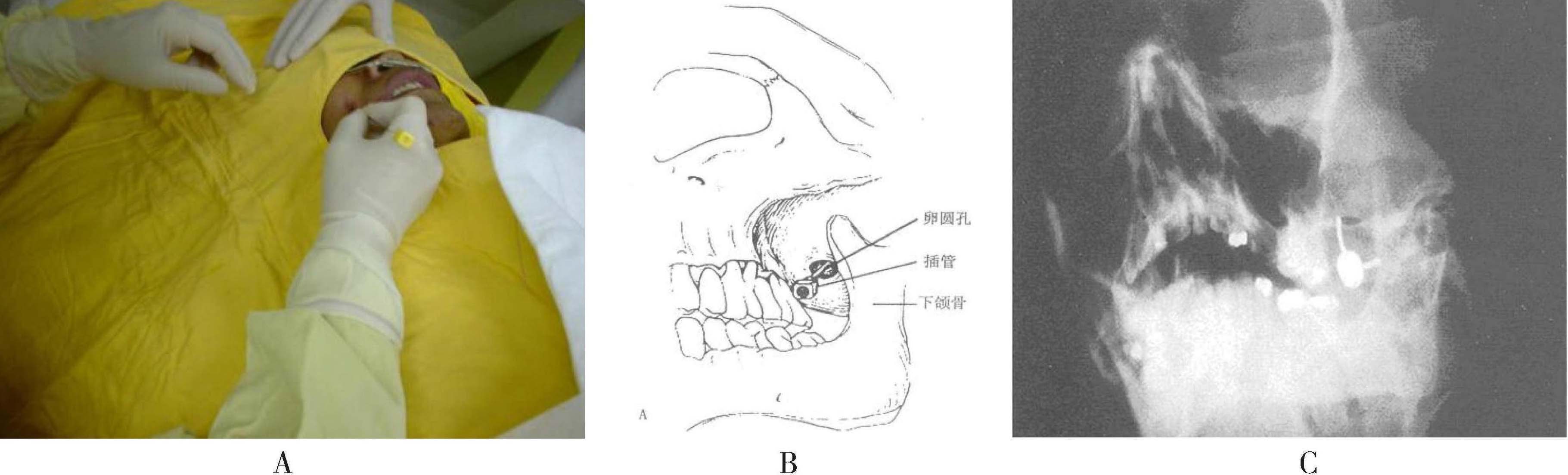 二、三叉神經(jīng)節(jié)射頻鎮(zhèn)痛術(shù)